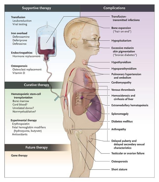 imdps_'s tweet photo. Thalassemia in short. #Haematology
https://t.co/p2QE4MUL5W https://t.co/lbqAQawR00