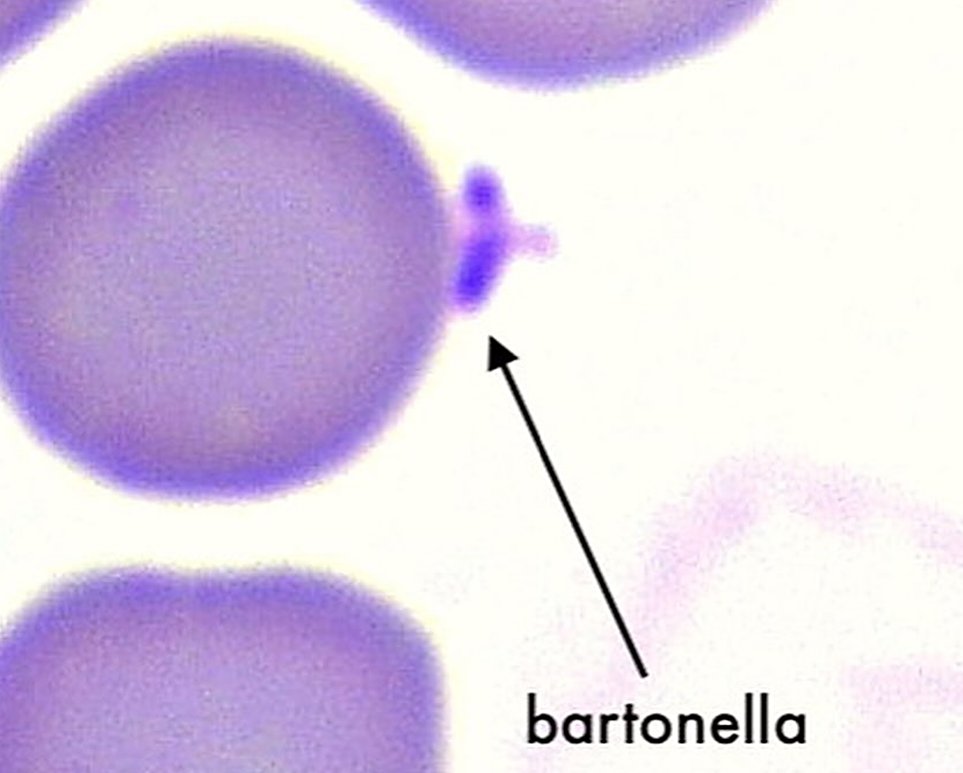 NEW CASE REPORT:
A woman diagnosed with Chronic Fatigue Syndrome (CFS) for 40 years!
A blood smear identified Bartonella grade 4, the highest grade.
She also had a diagnosis of celiac disease. When patients have such a severe infection, they often receive multiple diagnoses based