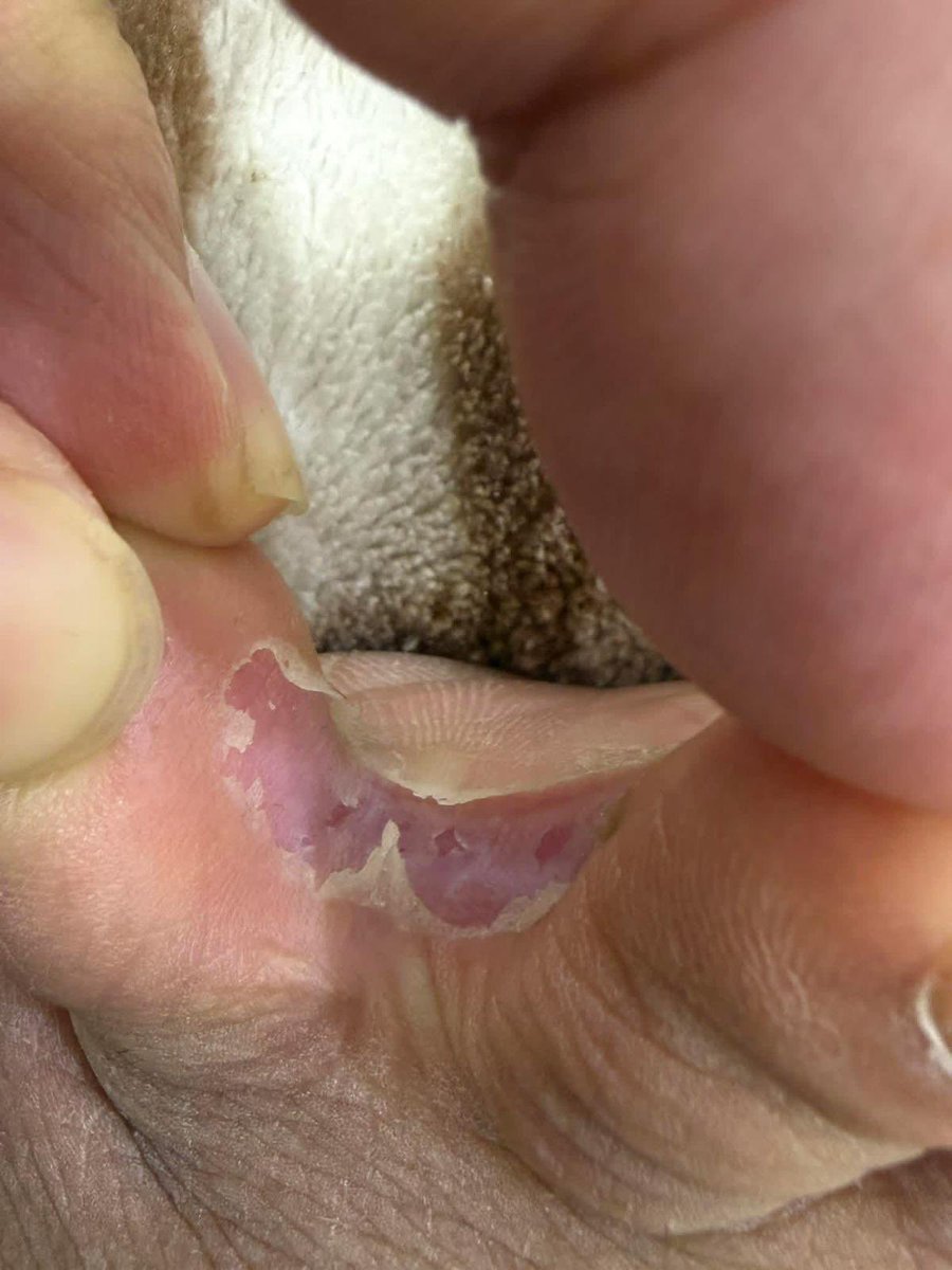 Dr_SaebGaza's tweet photo. Started This thing has appeared on my mother's foot and I'm worried Do you have any information about the cause and its treatment? https://t.co/CdhPnbXDnd https://t.co/6DRrUlxoAn