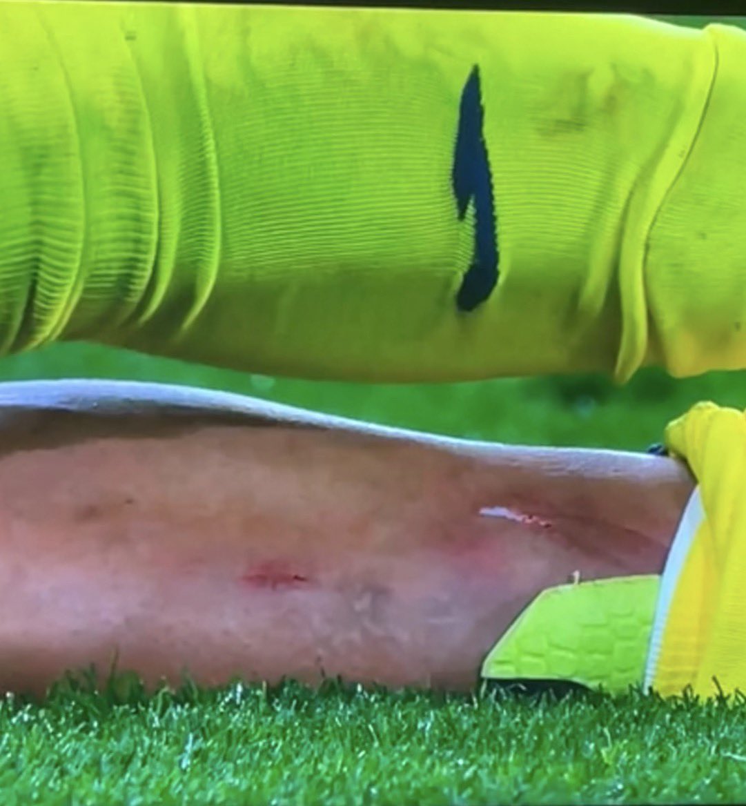 “Es que claro, esas espinilleras” Álvaro Benito