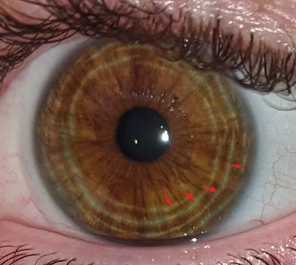 Everyone needs to take pictures of their iris and count how many activity rings they have.

Each one indicates production of hormones that require 1h of activity or 20 minutes of singing (3x faster) to use them up daily, otherwise those hormones cause anxiety.