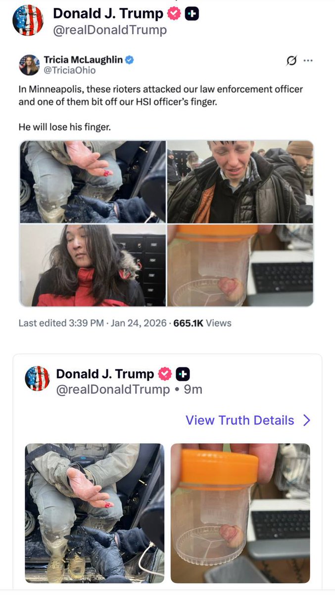President Trump posts the images of the HSI officer who had his finger bitten off by these psychotic demons.