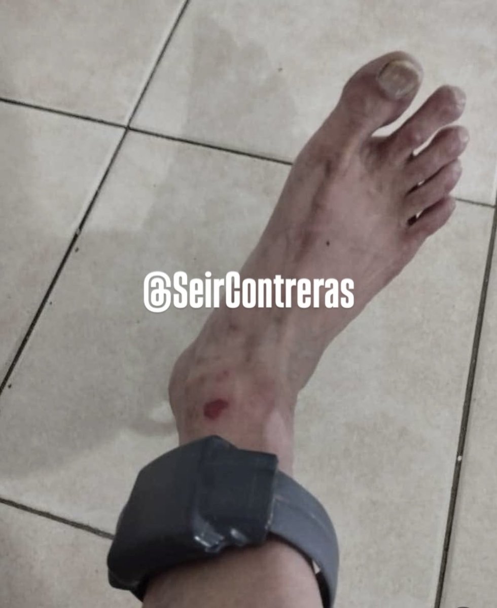 melania0880's tweet image. Estas imágenes no son propaganda.
Son prueba.

Así mantienen al alcalde de El Tigre, Ernesto Paraqueima:
con grillete electrónico, confinado en una vivienda del SEBIN,
en condiciones de humedad, deterioro y sin atención médica adecuada.

Fiebre, vómitos, lesiones visibles.…