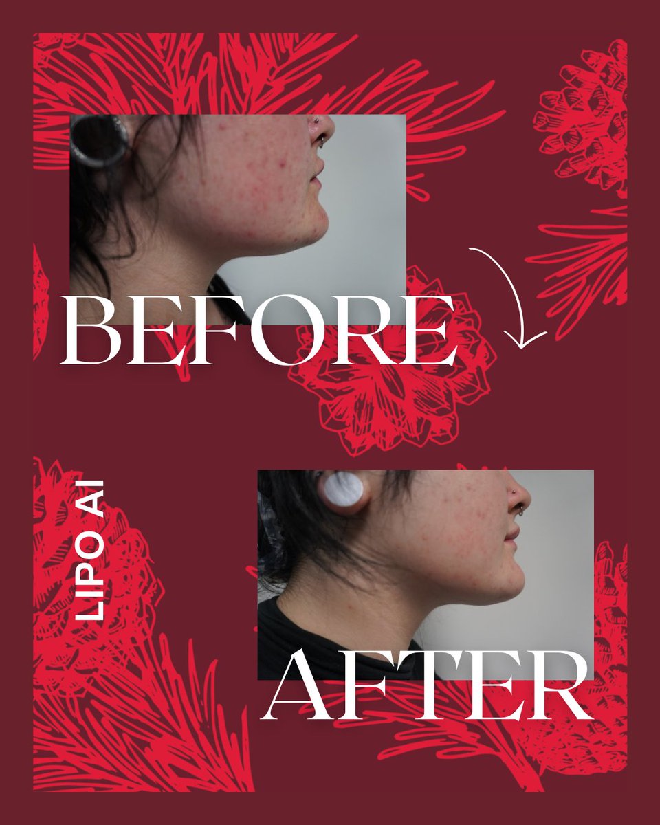 bellissimops's tweet photo. If you're noticing fullness under the chin that doesn’t respond to diet or exercise, LipoAI may be the solution. See the difference for yourself in this real Bellissimo result. https://t.co/qIq0TQLtiQ