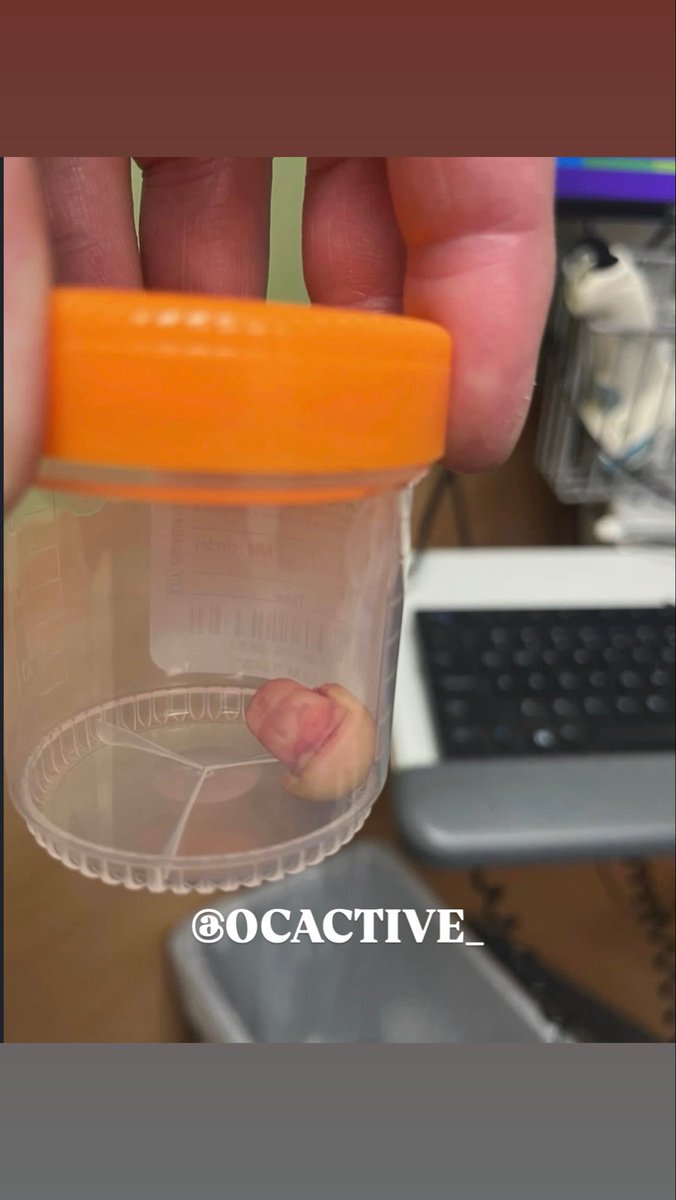 OCactive_'s tweet photo. Might wanna put that in Ice 🧊. Protester bit the tip of finger off ice 🧊 agent. What’s your Thoughts 💭 https://t.co/Vr2r2rNkKw