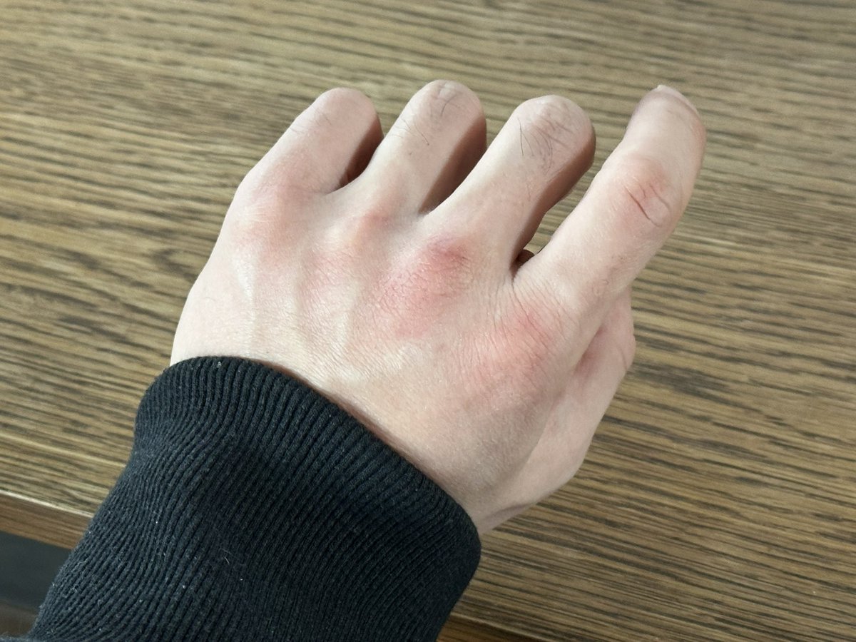 今年1月から、近くのボクシングジムに通い始めました。今日で3回目。チョーキツいけど、チョー楽しい。身体が熱くなると古傷が今でも赤くなるっぽい。空手はグローブしなかったから拳が破けて治るを繰り返します。30年も前の傷かよ…ご無沙汰してました。

#ボクシングジム #フィットネス
