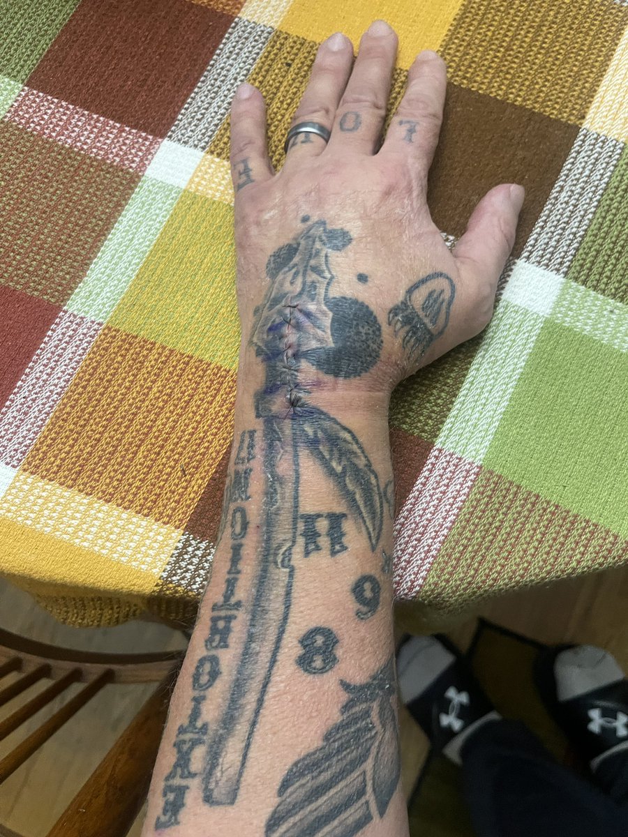 <a href="/Matt_Pinner/">𝐌𝐚𝐭𝐭 𝐏𝐢𝐧𝐧𝐞𝐫</a> Total wrist fusion after 4 breaks… then another with reconstruction.  Spinal tap to determine +MS diagnosis, (6 by nurse before Dr on 1st try), kidney stones, internal hemorrhoids removed by banding, polyps removed while awake.  5 or 6 broken noses, Broken ribs, and