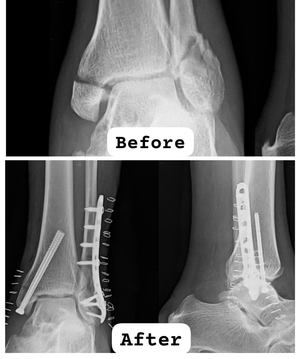 anconeus tweet media