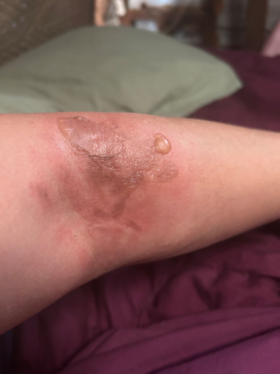 juliajayandbray's tweet photo. @kfc a faulty container full of gravy spilled on my arm, burning me pretty badly. I tried to send the incident through the contact us on the webpage. I have gotten replies but each one only asks for my name, address, and details of my feedback. Nothing else. https://t.co/VFAfC7x7jX