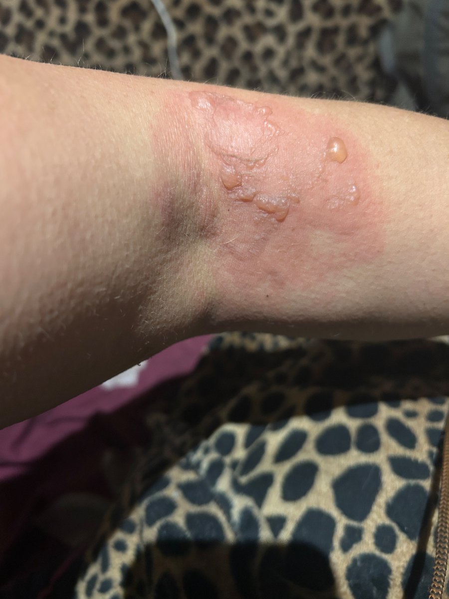 juliajayandbray's tweet photo. @kfc a faulty container full of gravy spilled on my arm, burning me pretty badly. I tried to send the incident through the contact us on the webpage. I have gotten replies but each one only asks for my name, address, and details of my feedback. Nothing else. https://t.co/VFAfC7x7jX