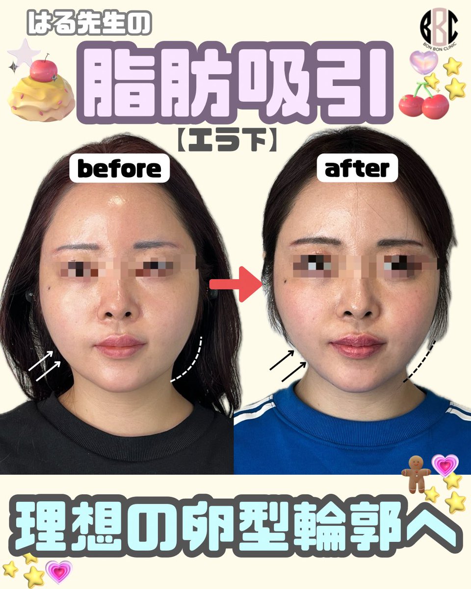 BONBONCLINIC's tweet photo. エラ下脂肪吸引　はる先生症例🫧✨

理想の卵型輪郭に🫶✨

https://t.co/Xk3PjY5OZF
☝️クーポンGET・ご予約はこちらから🫧

#脂肪吸引　#ジョールファット除去　#糸リフト　#ボンボンクリニック https://t.co/qlhiIOsFTs