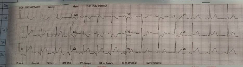 fsapradana's tweet image. Sedikit cerita tentang kemiripan nyeri akibat serangan jantung dan GERD.

Ada pasien yang katanya langganan GERD usia 40an awal, perokok berat. Suatu ketika datang ke IGD karena nyerinya sedikit lebih intens dari biasanya. Disertai mual tapi tidak muntah

Karena dokter IGD…