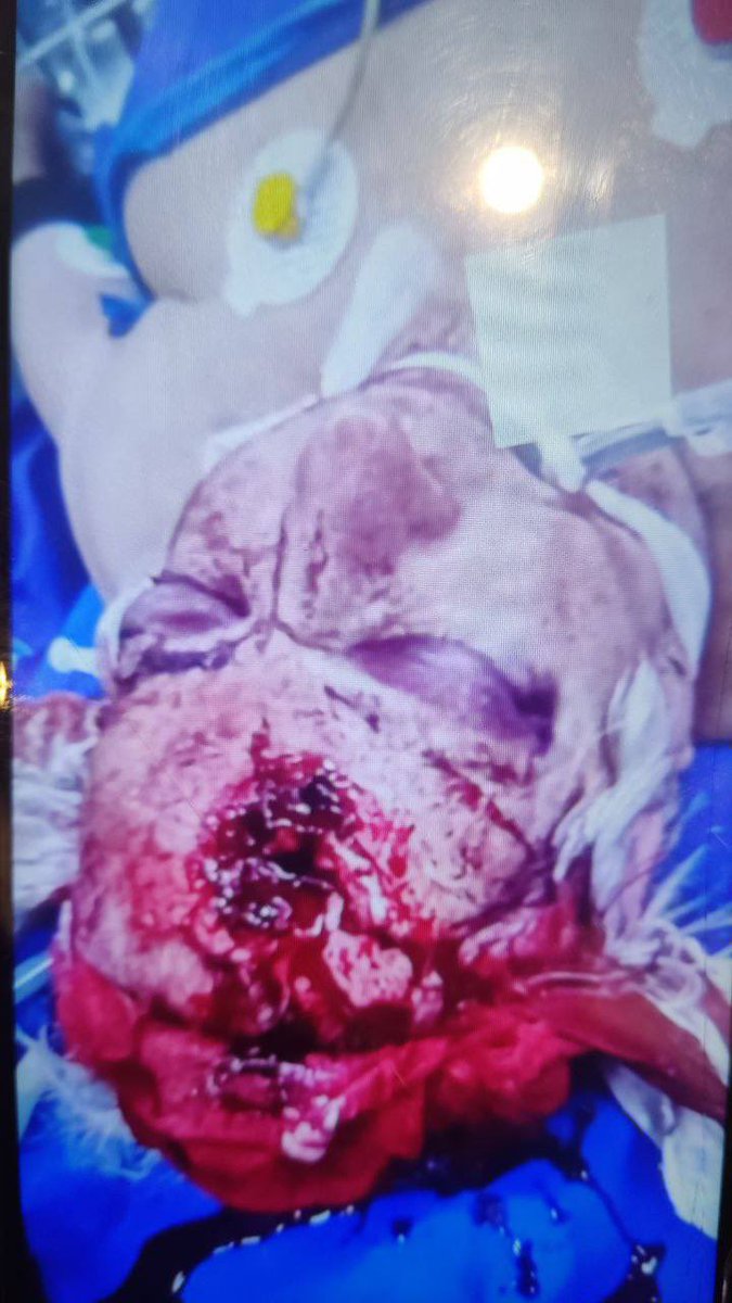 STILL_LOUIE's tweet photo. Among the bodies of Iranian protesters, there are many corpses seen with hospital medical equipment still attached to them, despite having been shot in the head. You don’t treat someone whose brain has been shot like this.
It looks like these patients were executed with a final shot while lying on hospital beds.
#IranMassacre