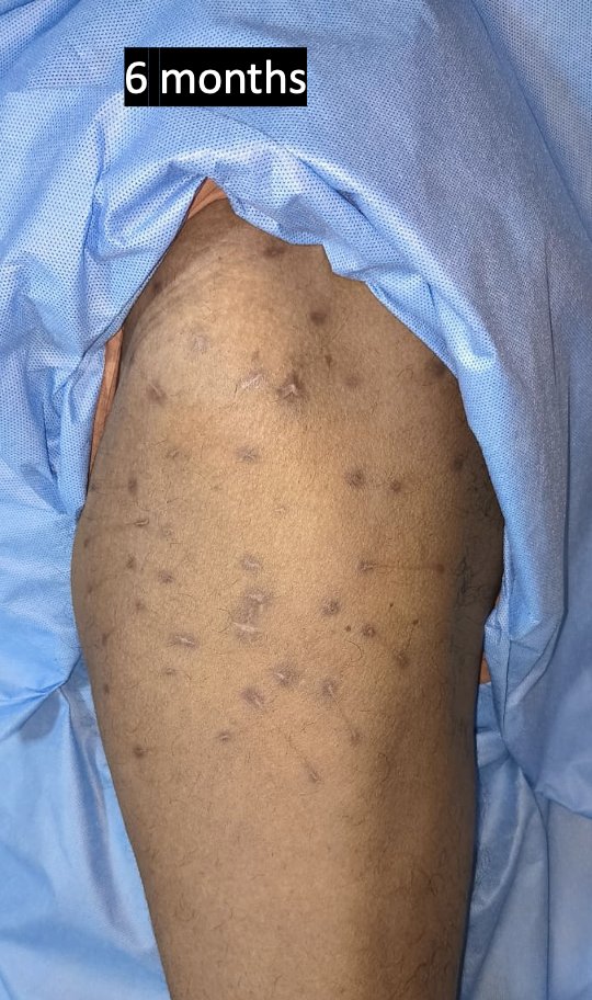 centerofhip's tweet image. Percutaneous quiliting in a  Morel-Lavalle lesion overlying trochanter.
#orthotwitter 
#orthoX
