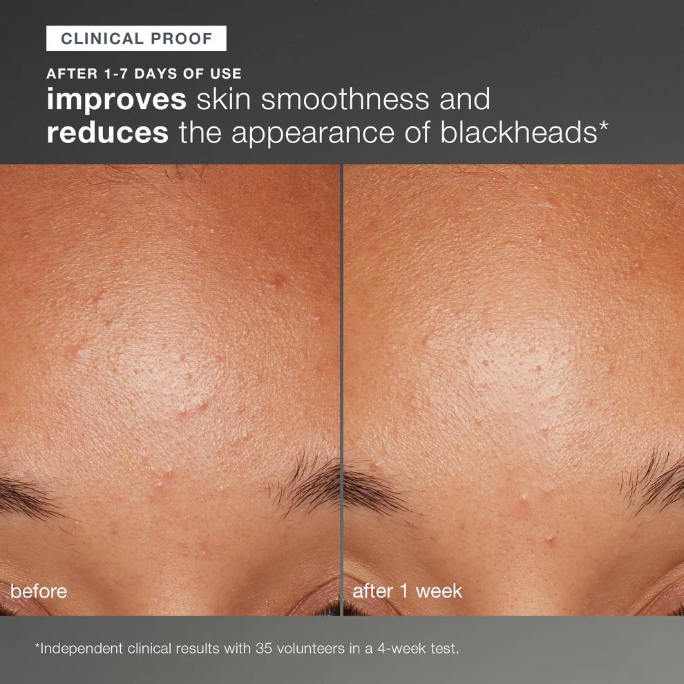 bubuxing's tweet photo. Dermalogica daily microfoliant (13g)
ดีมากๆๆๆๆๆๆๆๆๆๆ aka แฟ๊บซักหน้า 
แบรนด์ดังจากเมกา นำผงผสมน้ำจะเกิดเป็นฟองใช้สครับหน้าหลังจากล้างหน้าด้วยโฟม ช่วยให้ผิวสมูท เรียบเนียน กระจ่างใส ลดรอยดำ ลดสิวเสี้ยนได้ ภายใน 7วัน ใช้ได้ทุกวันเยย

ราคา: 400บาท 
(ปกติขวดใหญ่ในช็อป 2-3000บาท)
• ค่าส่ง 40บาท (ส่งรวมล็อตวิตามินฟรี)
• รอสินค้า 1 เดือน
• จ่ายตอนรับสินค้าในเกา
• Mention/dm