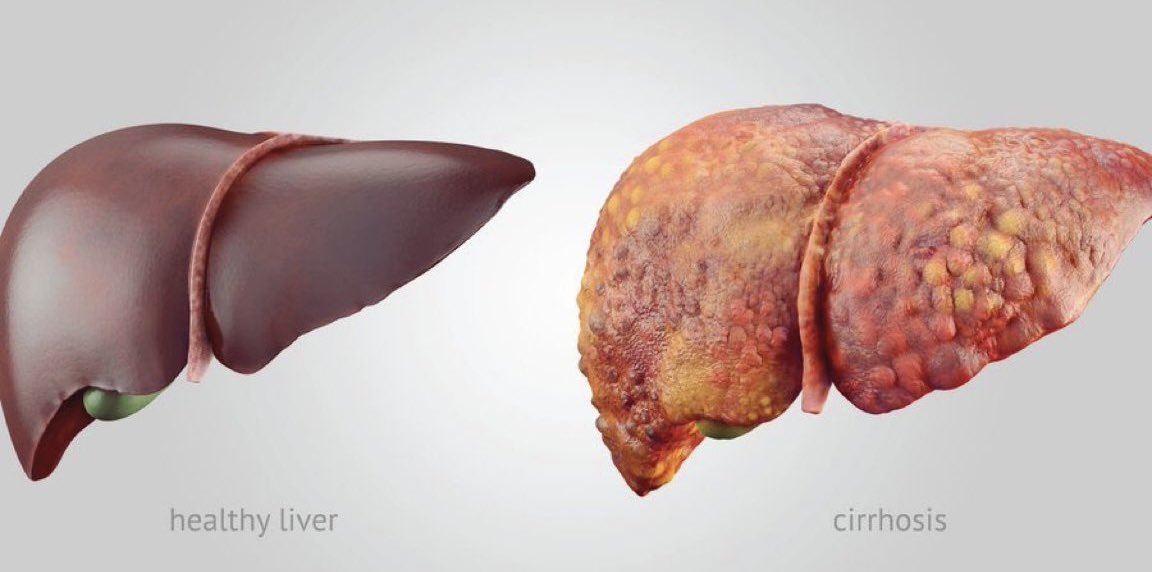 ReddCinema's tweet image. Drinking alcohol negatively affects the liver and leads to fatty liver called cirrhosis