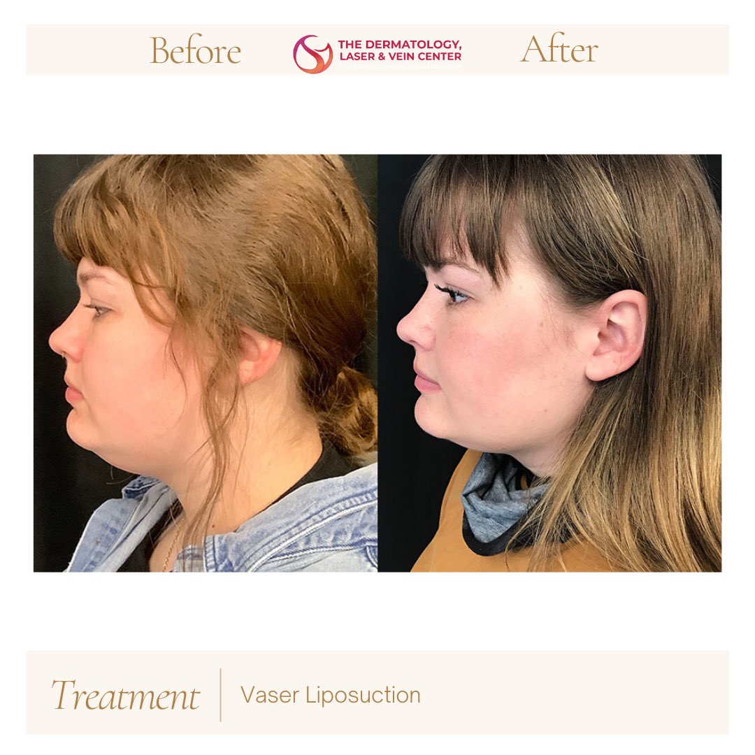 Laserctr's tweet photo. Subtle changes. Powerful confidence. ✨

This before &amp; after showcases refined results from Vaser Liposuction, designed to contour stubborn areas and enhance natural definition—especially along the chin and jawline. Small tweaks, big impact.

#VaserLiposuction #FacialContouring https://t.co/XO9WJIPbII