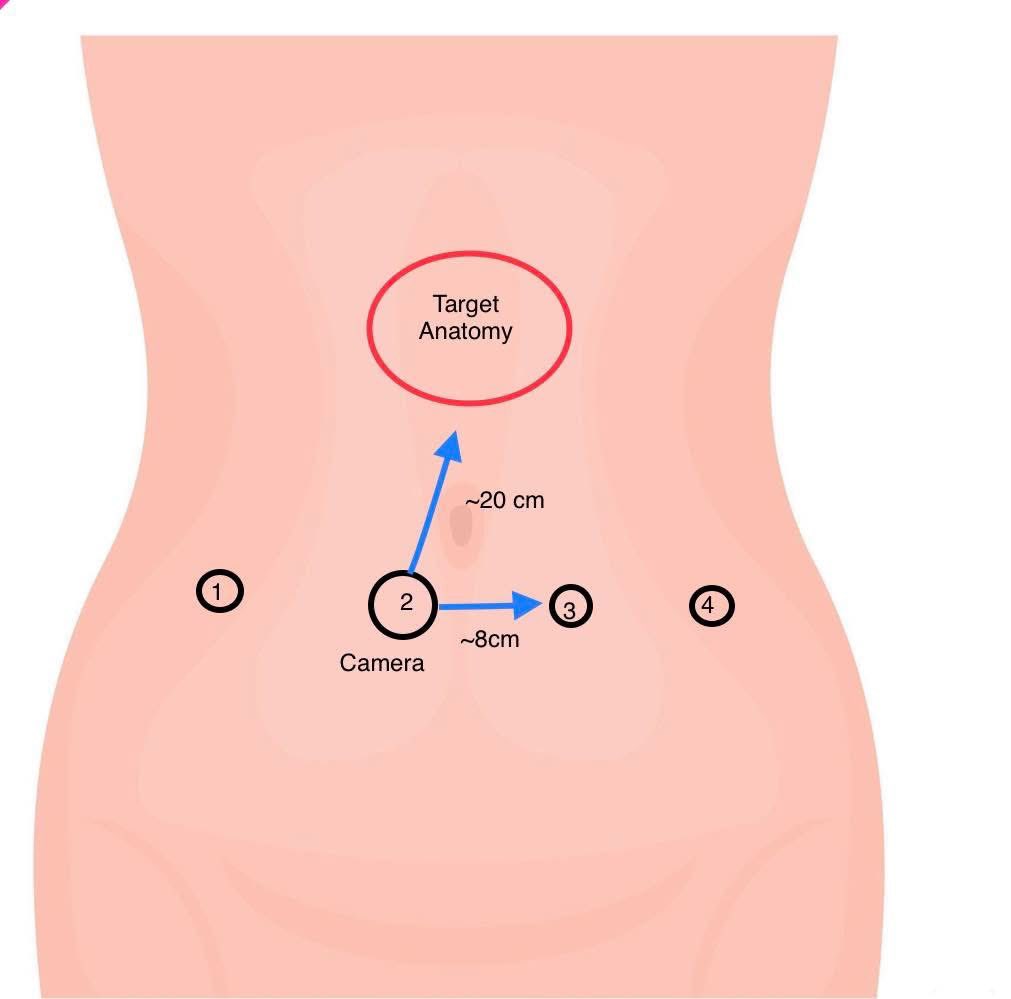 I’m often asked about port placement for different cases, but the principle is actually very simple. Position the camera about 20 cm from the target anatomy—whether that’s the gallbladder, appendix, liver, pancreas, uterus, or anything else. Then place the remaining trocars