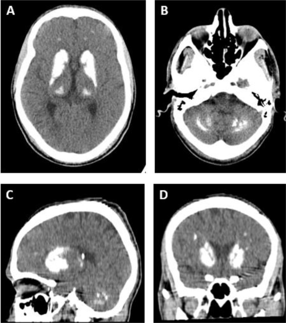 DocNavarrow's tweet photo. 🤵‍♂️47-year-old man presents with generalized weakness and fatigue. No prior neurologic or psychiatric history. Currently receiving chemotherapy for hepatocellular carcinoma. Brain imaging was performed to exclude acute pathology.

🧠👀Any thoughts? https://t.co/NFj0dV7ZFg