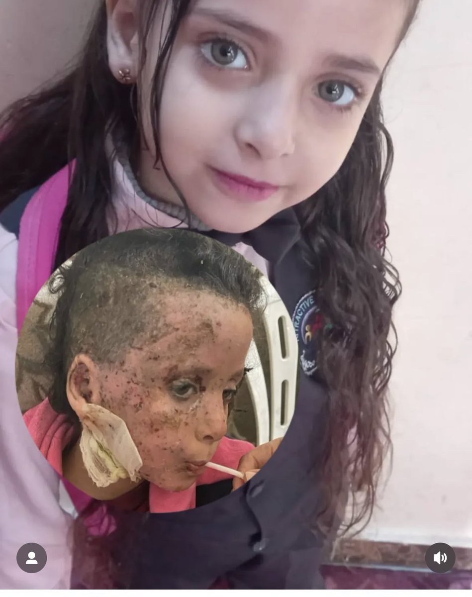 “Ben dünyalar güzeli bir kızdım, İsrail benim ailemi, çocukluğumu ve yüzümü aldı.” 💔