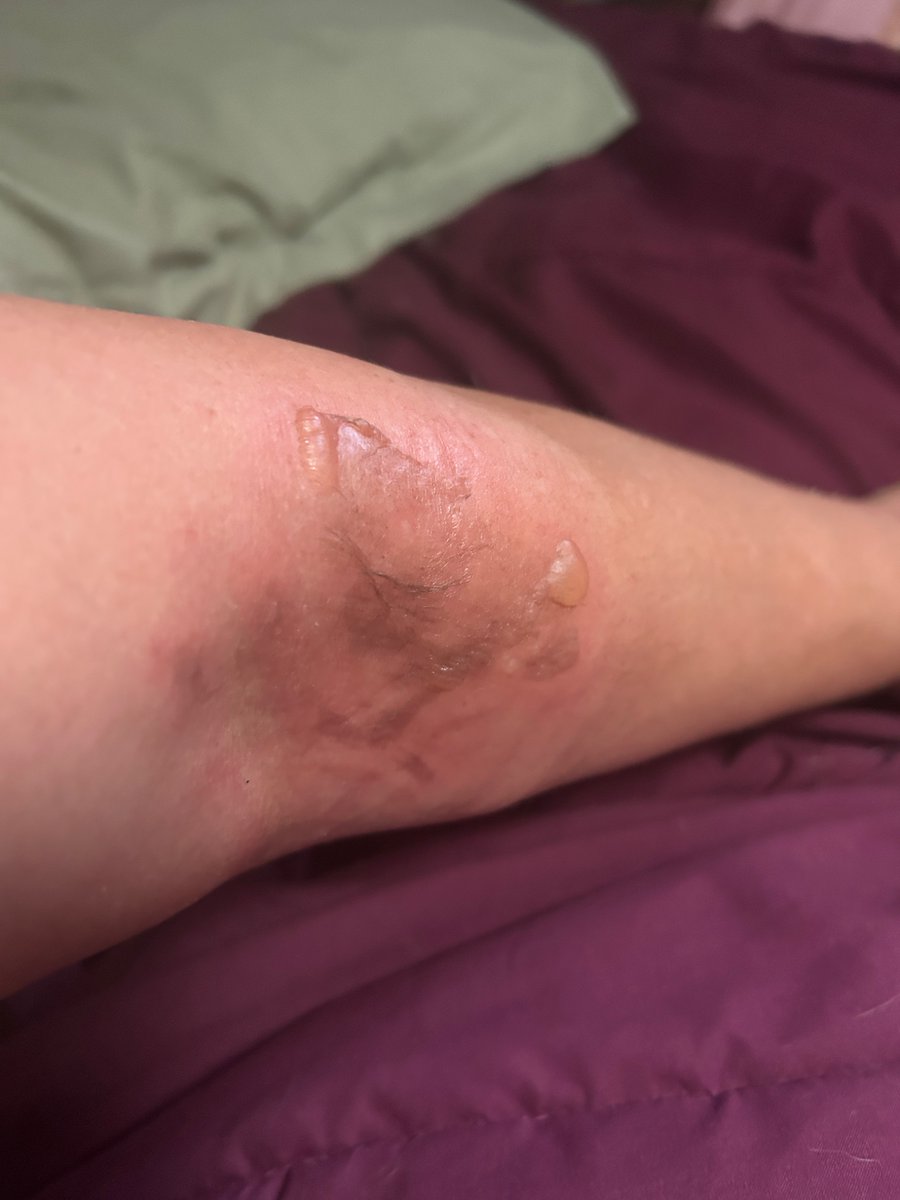 juliajayandbray's tweet photo. A container of gravy from KFC spilled on my arm. The faulty plastic tub broke open as my husband handed it to me. The gravy was so hot that it severely burned my arm. I have contacted KFC but have not received a response. 

@kfc https://t.co/3hSdogPY53