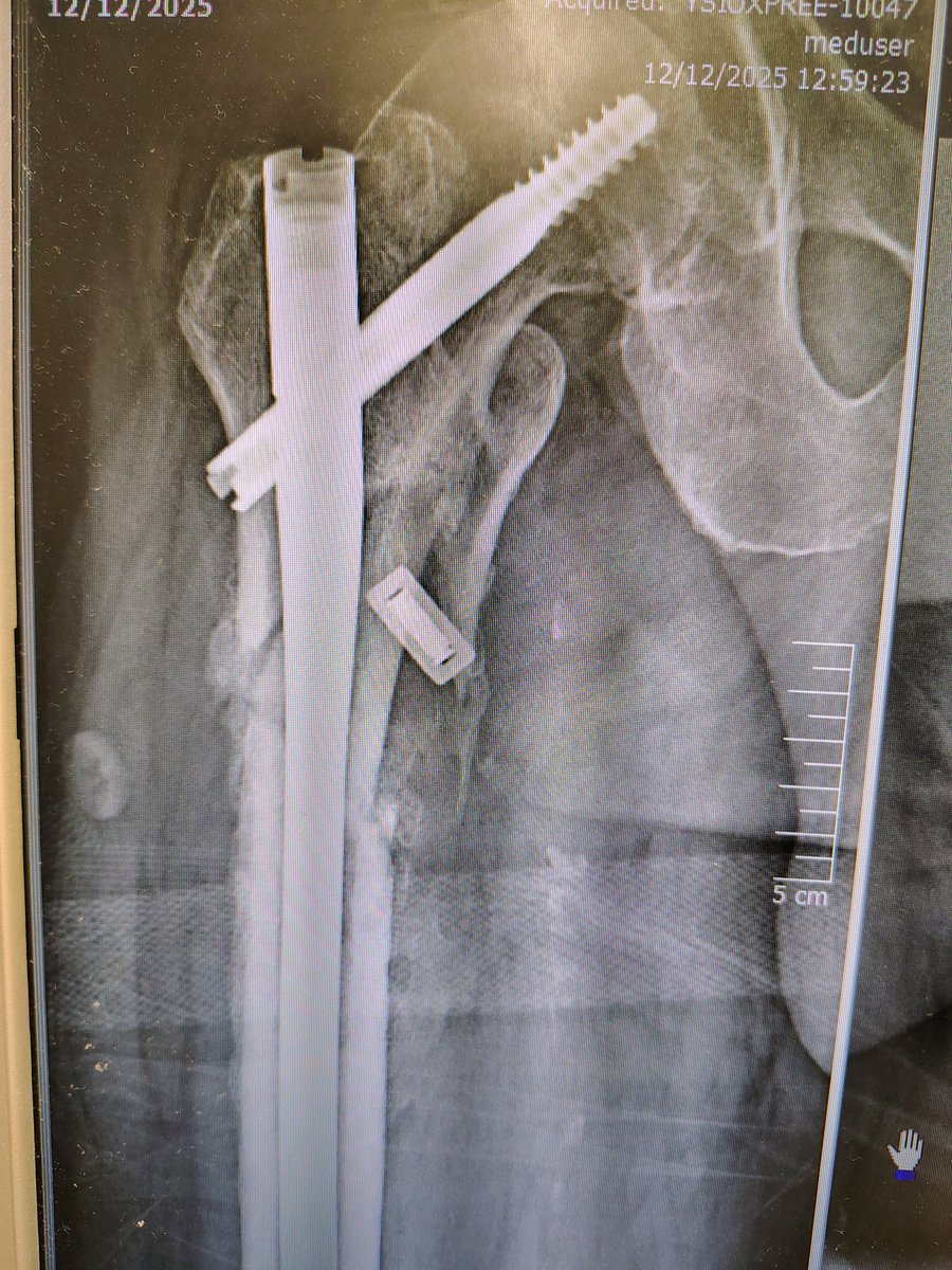 kostasd87's tweet photo. Distal locking failure
75yo comorbid gentleman, broke the distal locking screws of his Gamma2. Initially had a length unstable butterfly subtrochanteric fixed 5 months ago. Bloods negative, no signs of infection. New onset mild knee symptoms.
#orthotwitter