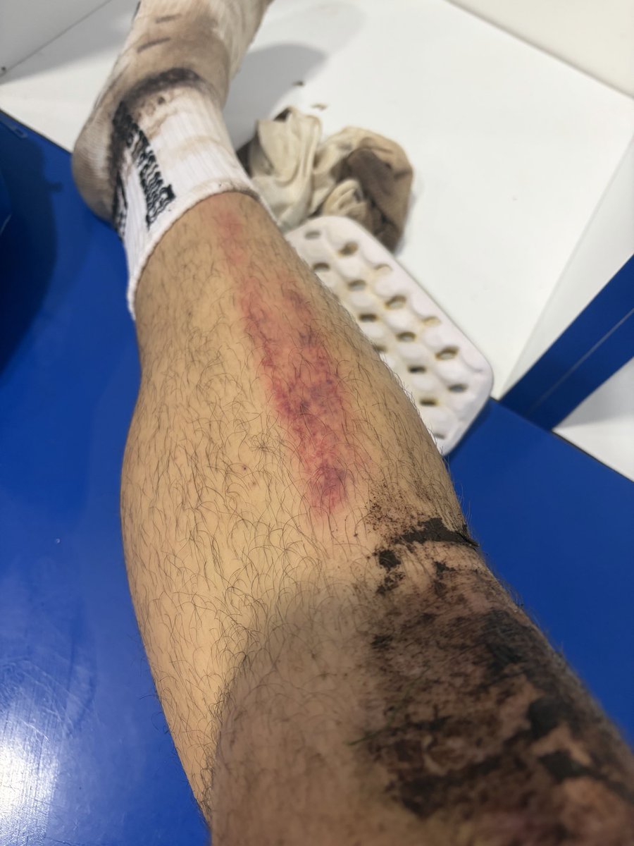 eloygl97's tweet image. 24 tíos entrenando bajo la lluvia y el frío a las 9 de la noche para que tiren todo el trabajo de esta manera… 
Entrada criminal de un jugador (ya con tarjeta) que me deja la pierna como se puede ver en la imagen.
Sigo debajo ⬇️
@CDArahalBpie  @Futbol_debarro_  @RegionalSevilla