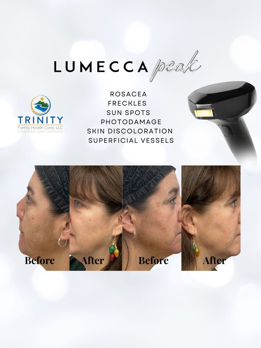 chad_fnp's tweet image. Look what lumecca can do!
#ipllaser
#inmode
 #trinityfamilyhealthcare