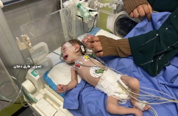 swilkinsonbc's tweet photo. Three month-old Palestinian baby Alma Abu Rida is fighting for her life in #Gaza due to prolonged malnutrition and a dangerous lung infection https://t.co/k9H5xj5BQE
