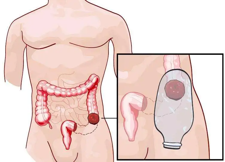 LM_Surgeon's tweet photo. 1/8 🧵COLOSTOMÍAS  #CirugiaUmaeVeracruz
“Ostomía” viene de ostium = una abertura/orificio/salida. 
#Colostomía ➡️ Derivación del colon a través de una abertura artificial en la pared abdominal. https://t.co/dEO4uKikTH