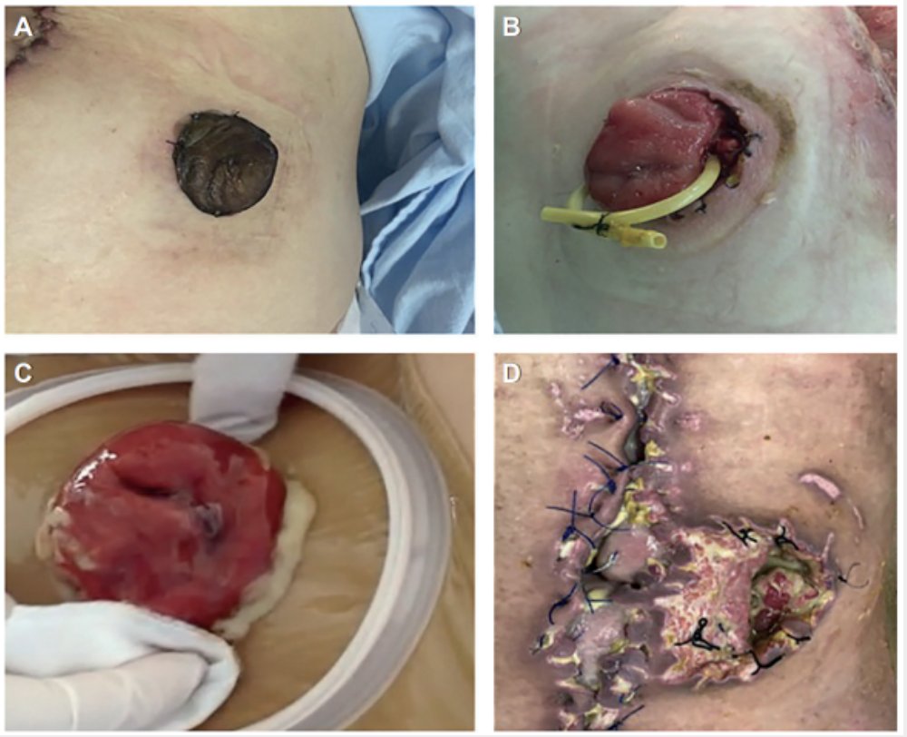 LM_Surgeon's tweet photo. 7/8 🚨 Complicaciones frecuentes:
A) Necrosis de la mucosa
B) Desprendimiento mucócutaneo/retracción
C) Absceso periestomal
D) Desprendimiento + absceso periestomal + fascitis. https://t.co/9SqRlNfO5L