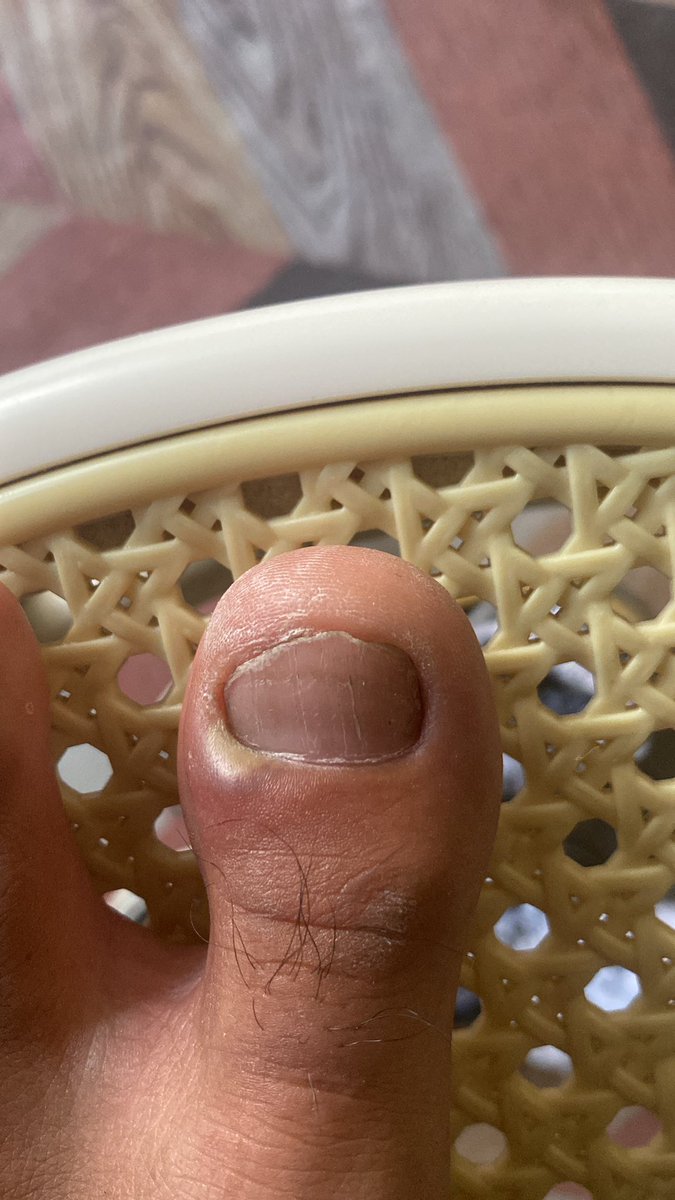 ithojiie's tweet photo. ingrown toenail, sakiit skalii wee 😭😭😭 https://t.co/CtQSQYaTB5