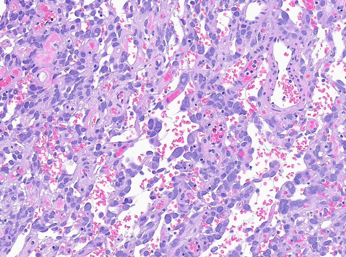 Greg_Charville's tweet image. What do you make of this tumor of the small bowel mesentery?🧐 #BSTpath #GIpath