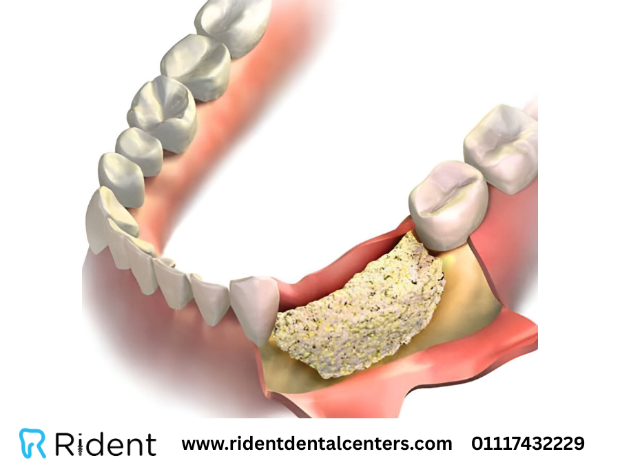 هل تعاني من فقدان عظم الفك؟
زراعة عظم الفك هي الحل الطبي الأساسي لتهيئة الفك لزراعة الأسنان بنجاح وأمان.
✔ تعويض نقص العظم
✔ زيادة ثبات زرعات الأسنان
✔ استعادة قوة وشكل الفك الطبيعي

📖 اقرأ المقال الآن:rebrand.ly/9xlo5vs
