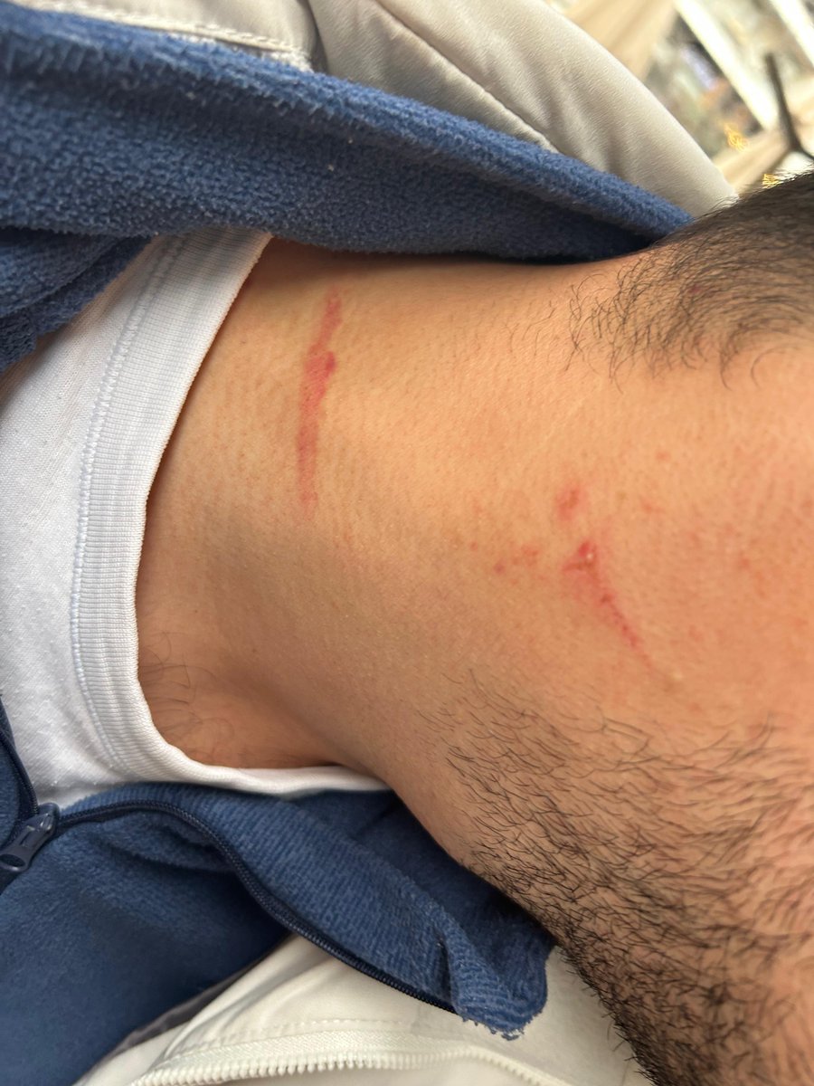 furkangztp's tweet photo. Fenerbahçe-Göztepe Maçında 
İstanbul’da polis şiddetine maruz kaldım
Polisler tarafından Haydarpaşa Numune Hastanesine götürüldüm.
Doktor darp raporu düzenlediğini söyledi ancak sisteme hiçbir rapor girilmedi.

İzmir’de tekrar hastaneye gittiğimde darp raporu aldım ve İstanbul’da https://t.co/fkiRay3vCd