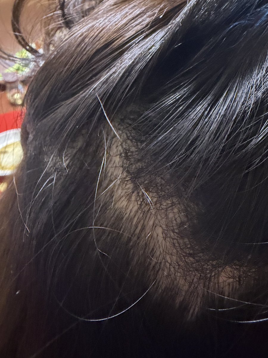 韓国🇰🇷で植毛した傷跡、マジでどこか分かりません😂 母👩に探してもらっても「この辺…？」って迷うくらい自然！！ トルコ🇹🇷みたいに全剃りしなくていいし、ダウンタイムもほとんどなくて渡韓して本当に良かった❤️  M字や傷跡ハゲで悩んでる人に届いてほしい ...