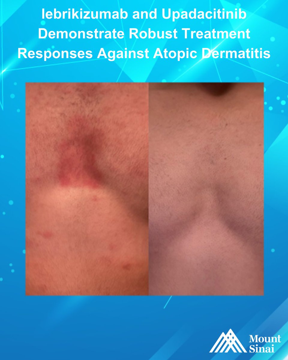 Mount Sinai Dermatology tweet media