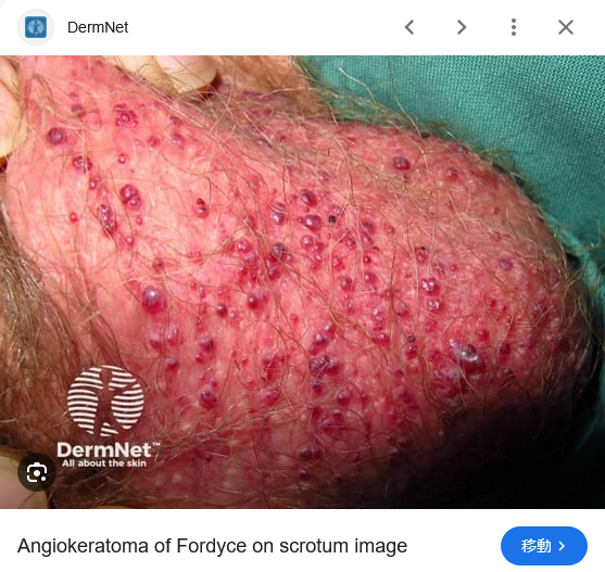 🅰️KFutoshi💯 Scrotal Bleeding. 陰嚢出血 tweet media