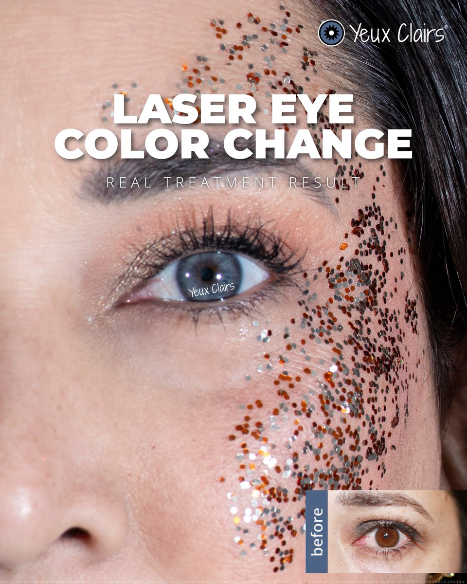 Consider this your official certificate of shine. 📜✨

More results: yeuxclairs.com/gallery
#LaserEyeColorChange #PermanentResults #SafeAndPainless