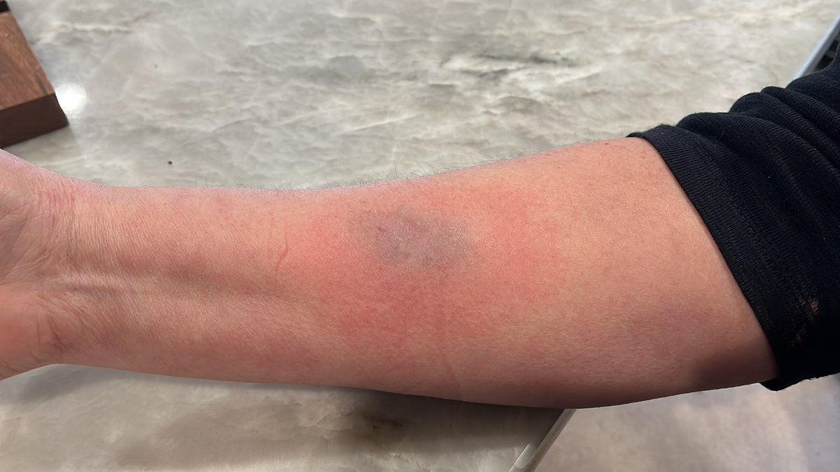 AlejandroGuad12's tweet photo. @QuestDX My wife went in for lab work at your 925 Gessner Rd #490, Houston, TX 77024 . My wife knows her body pretty well and she requested a few things which her technician (ky or something like that) disregarded. Wife now has a 3” bruise and bleeding. Just unacceptable !! https://t.co/ySH8q6WQGM