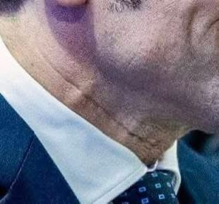 🚨 SOMETHING ISN’T RIGHT - MACRON’S NECK LOOKS VERY STRANGE

First the black and red eye.
Then the sunglasses worn indoors.
Now this.

Does this look normal to you?