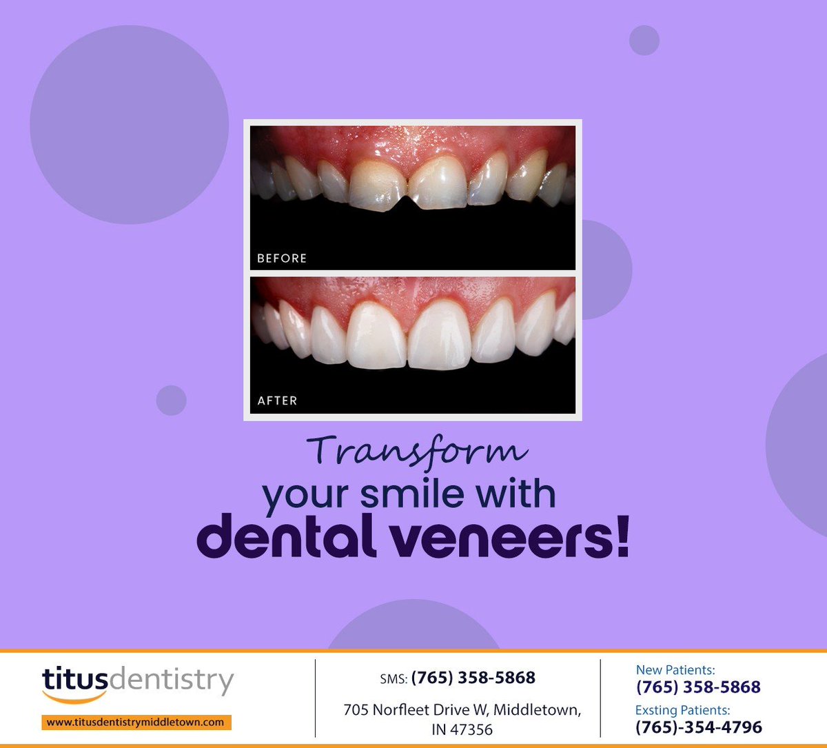 titusdentistry's tweet image. Restore your smile with the help of dental veneers. Schedule a consultation at titusdentistrymiddletown.com to learn how this treatment can transform your smile. #dentalveneers #smiletransformation #smilewithconfidence #titusdentistry #middletown #IN