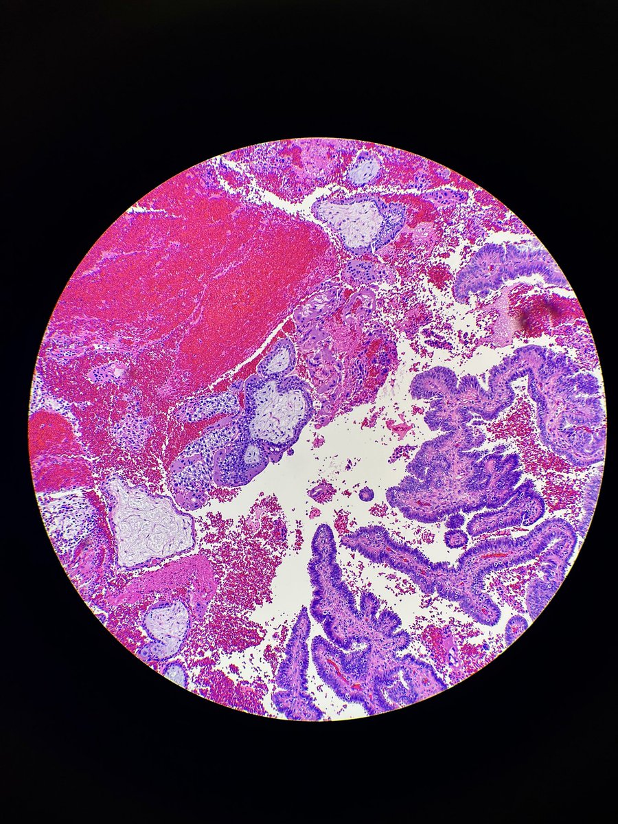 Babker_Path's tweet photo. Quick #Monday_pathology_catch 🔍
🫣Blink-and-you-miss-it.
#Ectopic = right tissue, wrong place. Tubal wall pays the price.
#PathX #Pathology #OBGYN #GynecologicPathology #PathTwitter https://t.co/J8KO3dVYZx