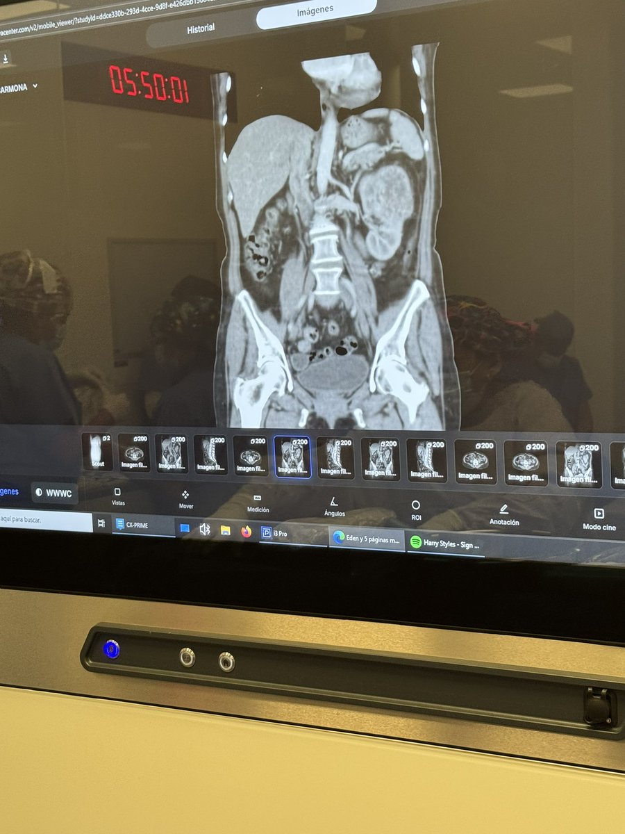 Doc_Moon's tweet image. Oncoteam.  Nos tocó quitar un cáncer de riñón.  Intento curativo. #surgeonlife #cancer #surgeons