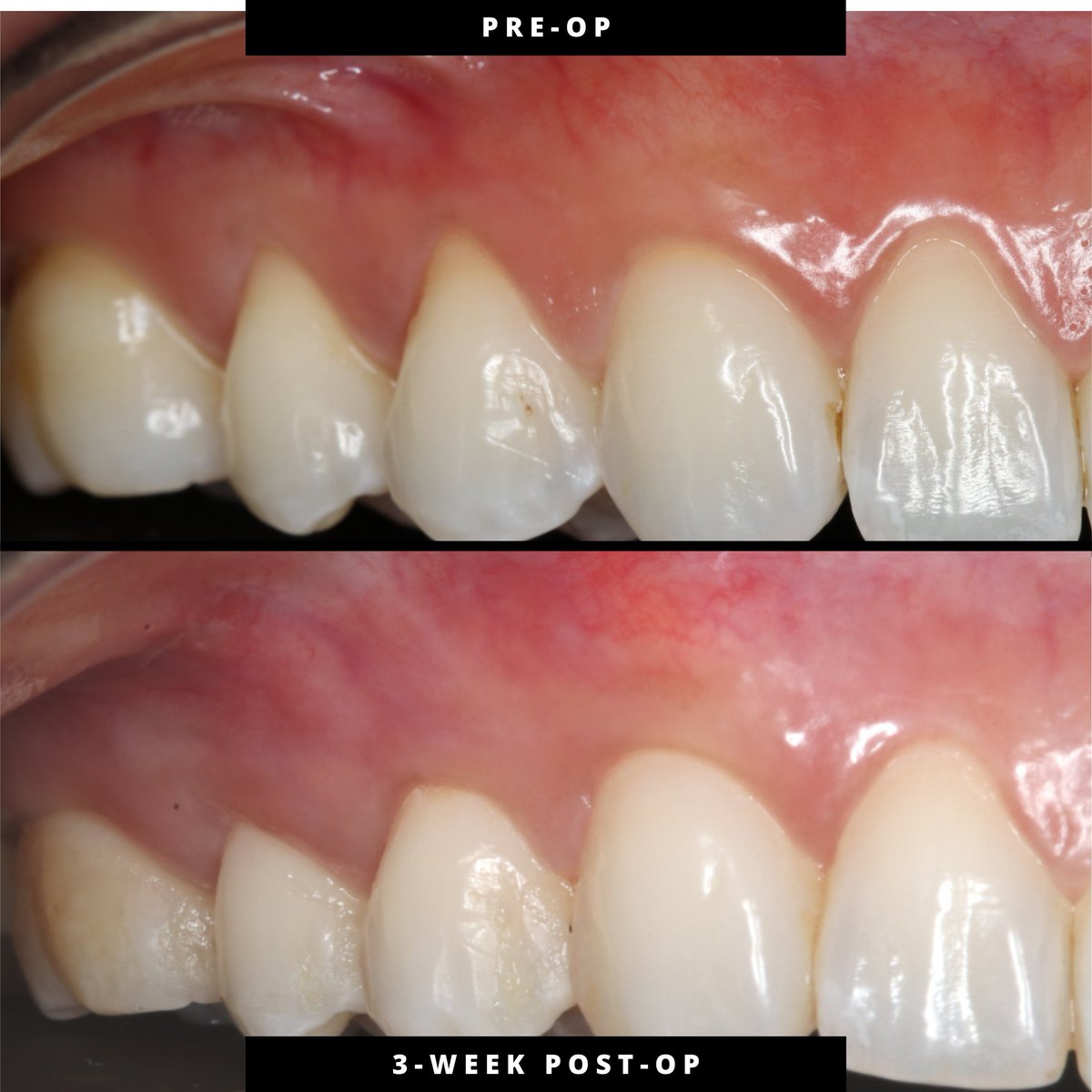JohnChaodds's tweet photo. Pinhole® Surgical Technique — Clinical Observation

3-week post-op following treatment of gingival recession at #3–5 and #12–15.
Early healing demonstrates tissue continuity and expected erythema. Final margin position remains biologically undetermined. https://t.co/dfV91bK22z