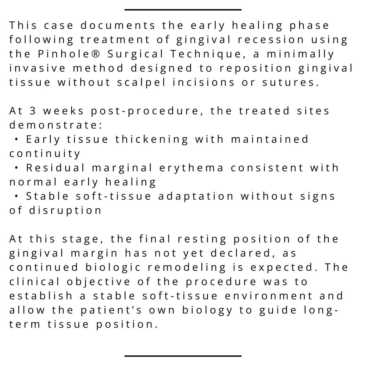 JohnChaodds's tweet photo. Pinhole® Surgical Technique — Clinical Observation

3-week post-op following treatment of gingival recession at #3–5 and #12–15.
Early healing demonstrates tissue continuity and expected erythema. Final margin position remains biologically undetermined. https://t.co/dfV91bK22z