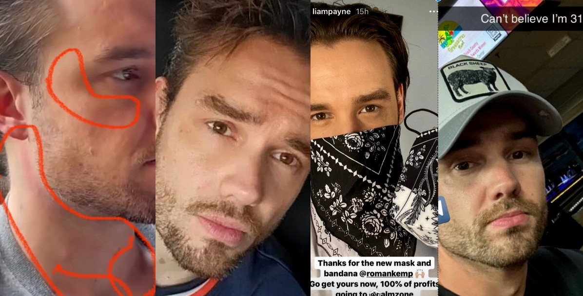 sweetmotivs's tweet photo. The autopsy report that was seemingly rushed claimed that Liam’s injuries were due to the fall. However, forensic specialists question how Liam got the amount of injuries that he had because of the simple fact that they’re inconsistent with a three story fall. 

We know that Liam was often bruised up, had black eyes, a busted lip, welts, etc. and he was in this kind of shape up until he died. We also know that it was said that Liam was extremely paranoid prior to his death, by both Braian and fans. He was so scared that it caused him to keep people out of his room. 

Why was he so afraid? Who was he afraid of? Who was abusing him? Is that even being looked into? Are they SURE that Liam’s injuries are from the fall and that they weren’t suffered beforehand? How are they so sure? 

#JusticeForLiam #JusticeForLiamPayne #ExposeTheCorrupt #LiamPayneAppeal #WeWillNotBeSilenced @FiscalesGobAr @TMZ @telefenoticias @infobae @todonoticias @dailymailuk