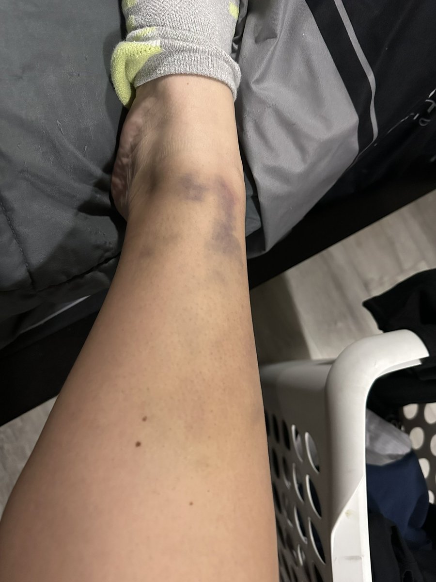 I highly suggest not getting into a car accident and having your airbags deploy!! Almost 2 weeks since my accident and my leg is still swollen