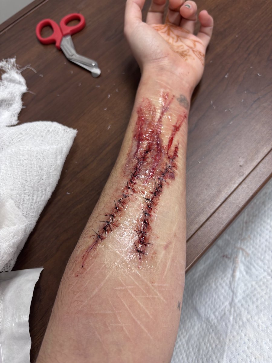 casperjaxx's tweet photo. Relapsed after 3 years. #shtwt https://t.co/H0h4VYwQnS