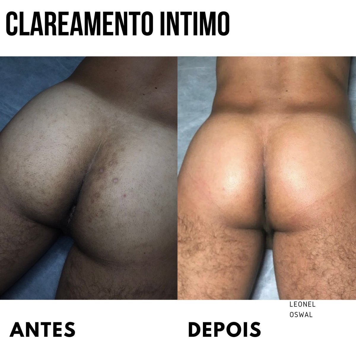 Clareamento Íntimo 5 sessões #esteticamasculina #estetica
